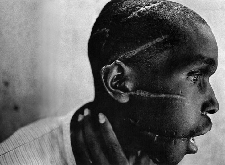 A Rwandan boy left scarred after being liberated from a death camp.
