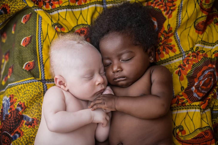 3 weeks old infant with albinism snuggles up to his cousin for a snooze.
