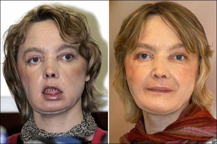 21st century photos - Isabelle Dinoire after receiving the world's first partial face transplant [2005]