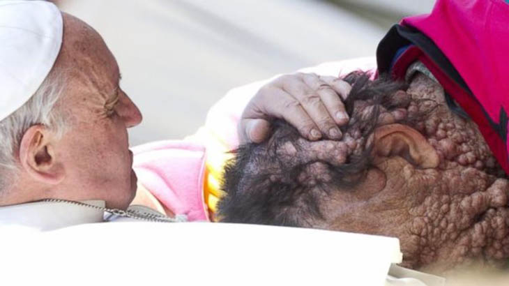 Pope Francis embraces Vinicio Riva, a man scarred by a genetic disease.