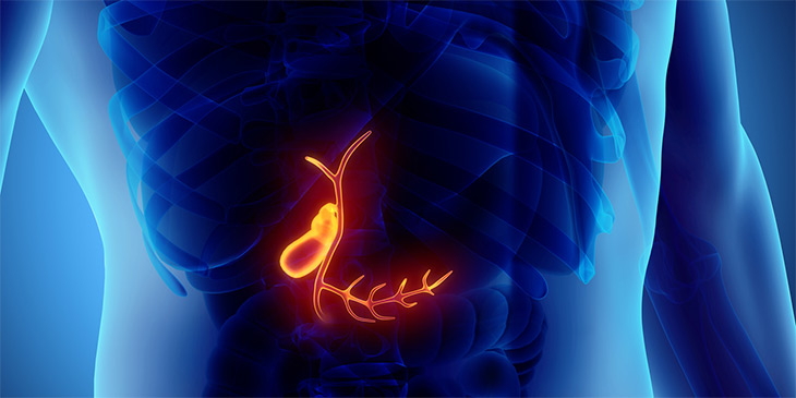 Gall Bladder Stones